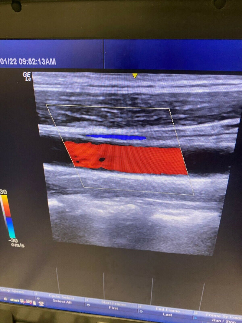 Load image into Gallery viewer, GE Logiq E NextGen Portable Ultrasound with L14-12t-Rs & L8-18i-Rs Linear Screen